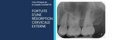 Cas Clinique : Découverte fortuite d'une résorption cervicale externe