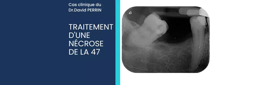 Cas Clinique : Traitement d'un nécrose de la 47