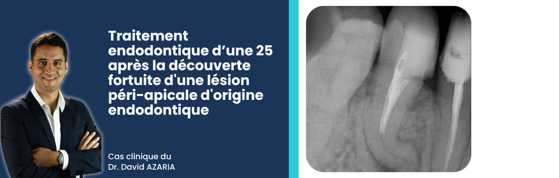 Cas clinique : Traitement complexe sur une 25 avec double courbure serrée