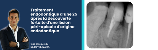 Cas clinique : Traitement complexe sur une 25 avec double courbure serrée