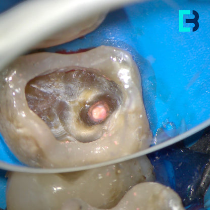 Micro-tenons fibrées Biolight-Plus pour reconstitution corono radiculaire a minima