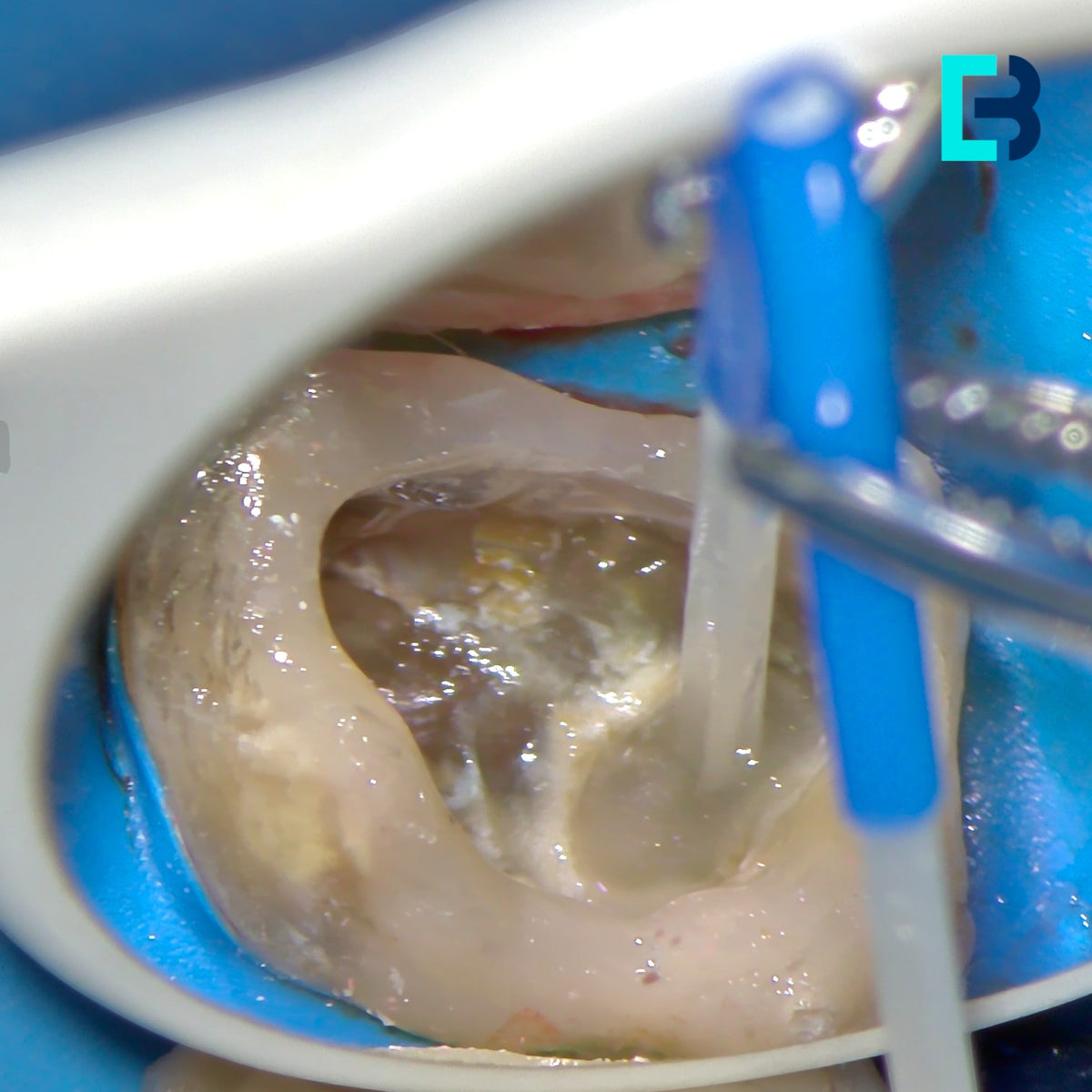 Micro-tenons fibrées Biolight-Plus pour reconstitution corono radiculaire a minima