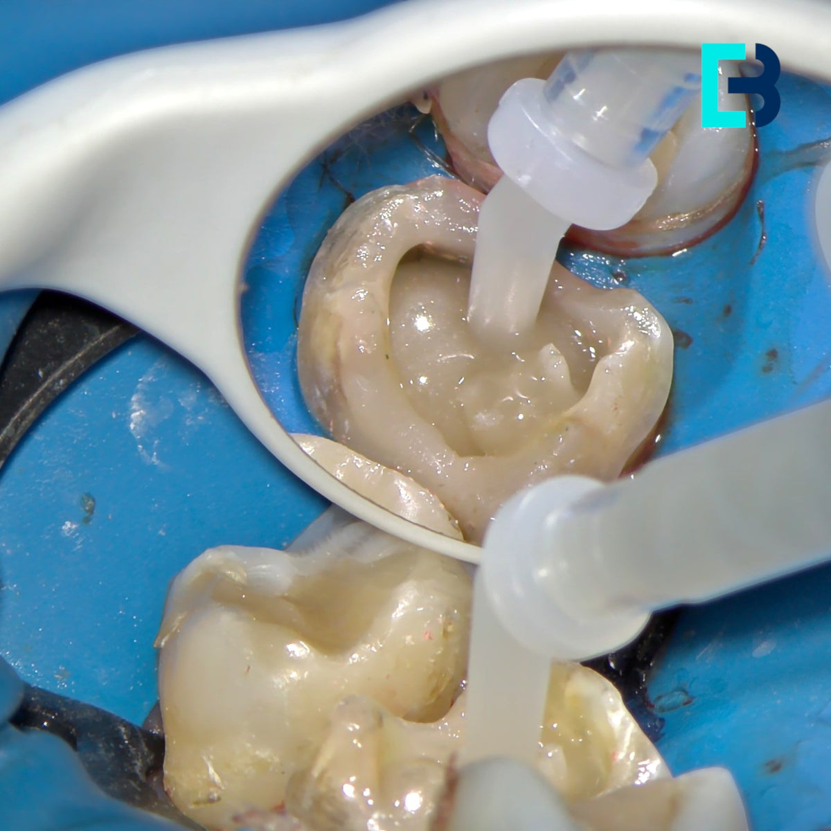 Micro-tenons fibrées Biolight-Plus pour reconstitution corono radiculaire a minima