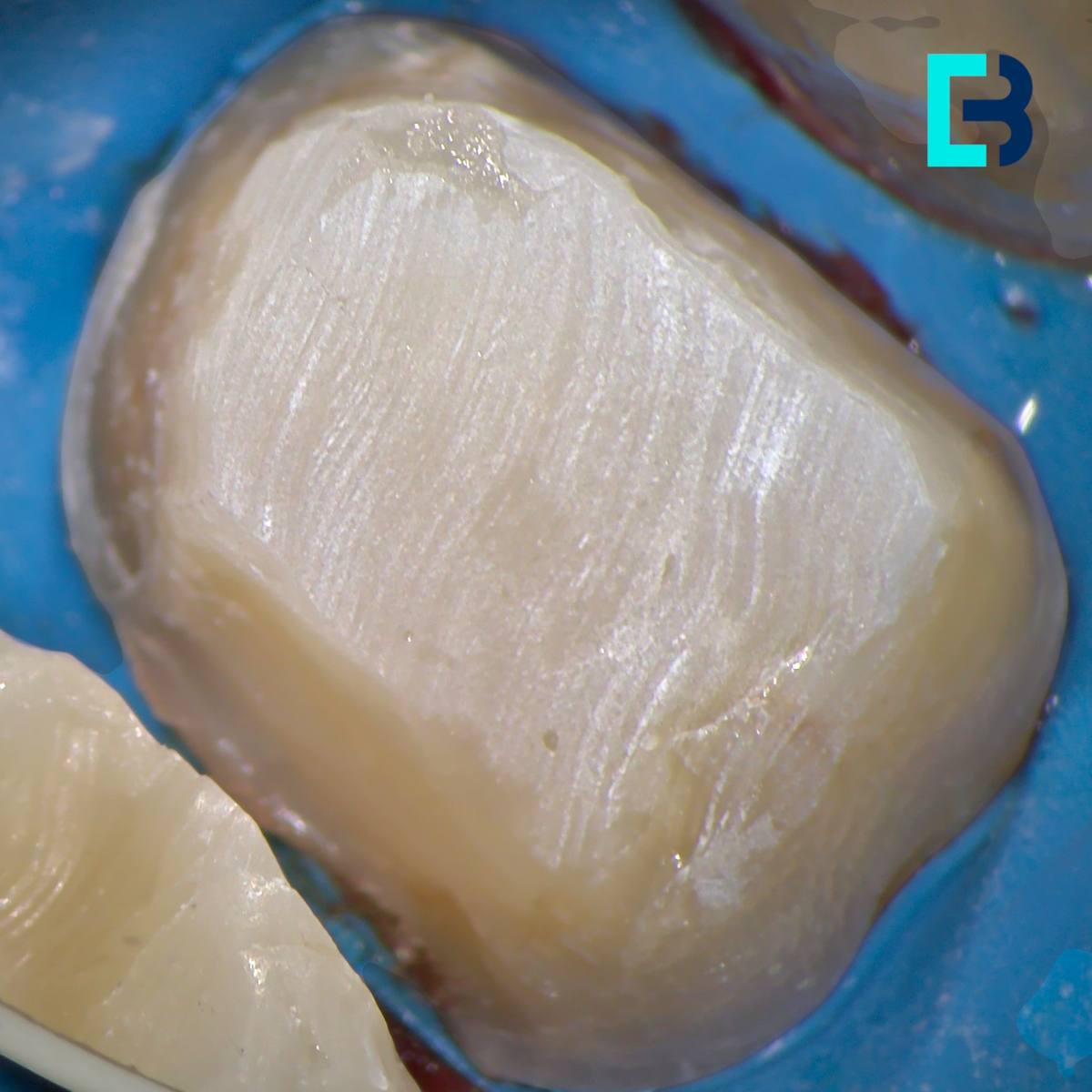 Micro-tenons fibrées Biolight-Plus pour reconstitution corono radiculaire a minima